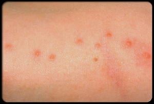 bed bug bites